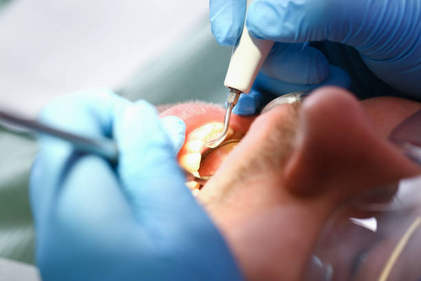 Best Emergency Dentist for Lost Fillings or Crowns in Vamo, FL