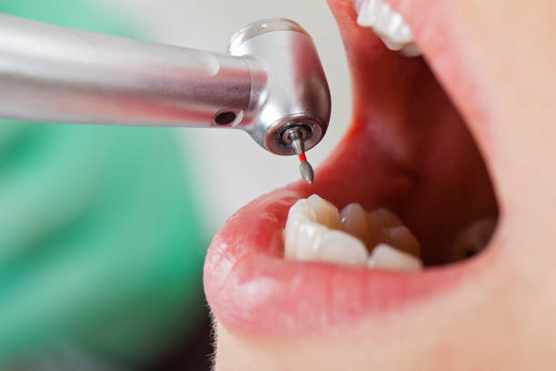Best Emergency Root Canal Treatment in Vamo, FL